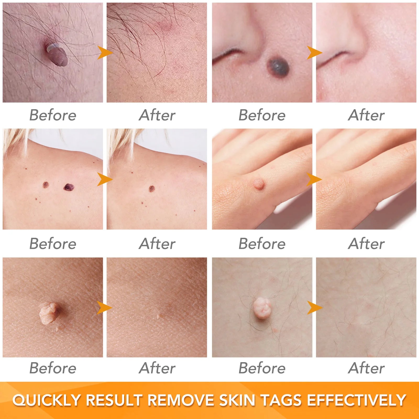 Simple Wart Removal Tool Set Skin Tag Removeal Tool Easy To Clean Skin Care Tool Skin Tag Removal Care Products