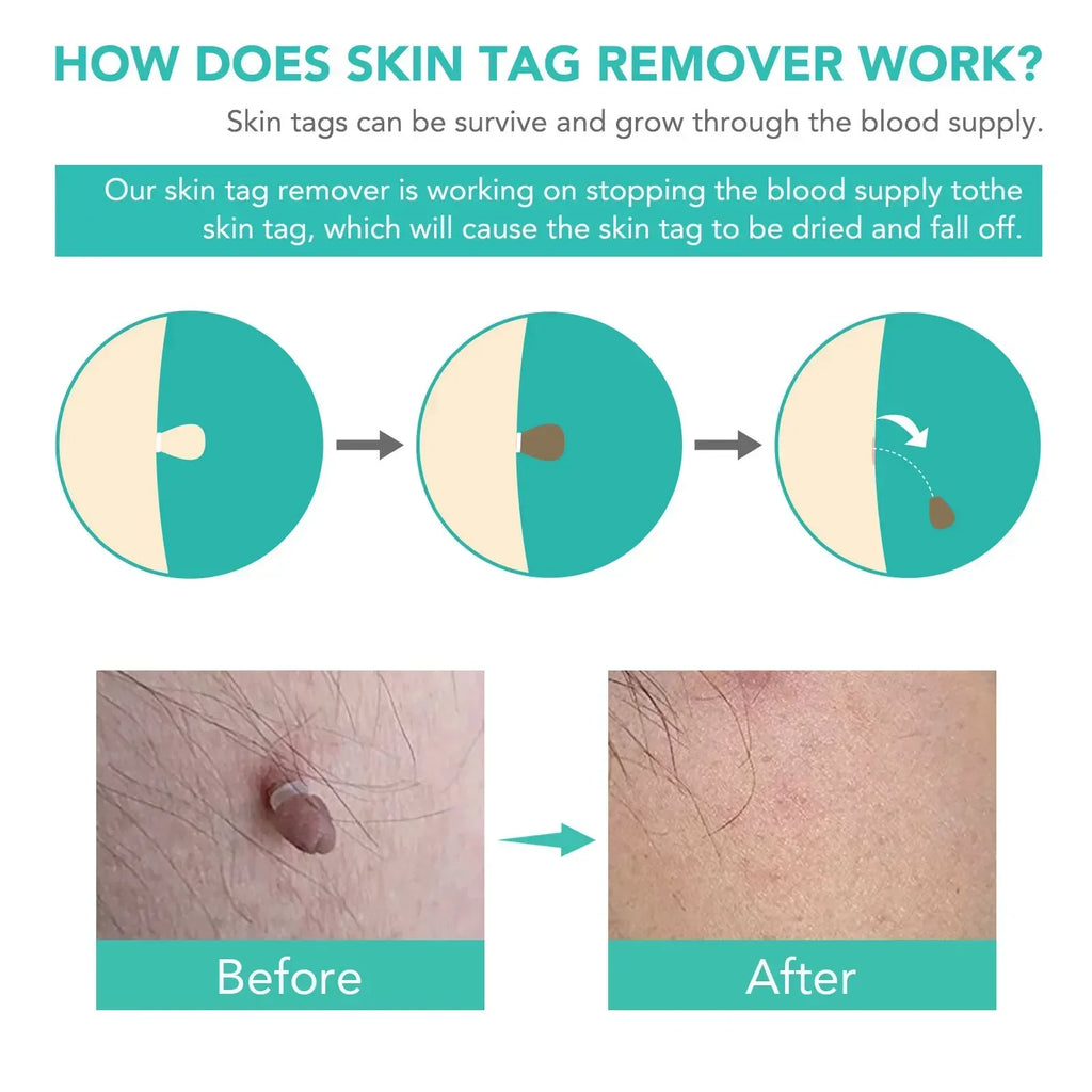 Skin Tag Removal Care Products Simple Wart Removal Tool Set Skin Tag Removeal Tool Easy To Clean Skin Care Tool
