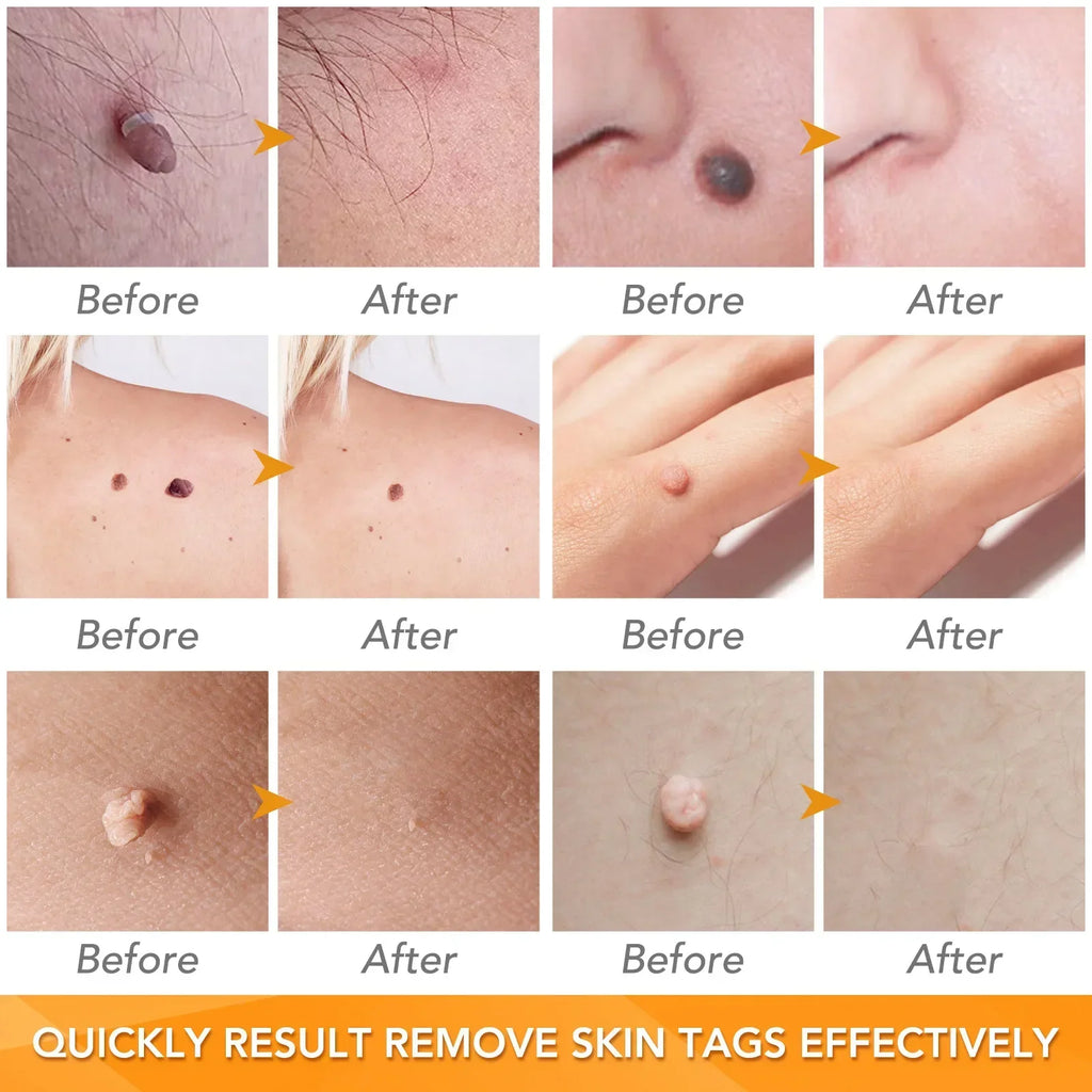 Skin Tag Removal Care Products Simple Wart Removal Tool Set Skin Tag Removeal Tool Easy To Clean Skin Care Tool