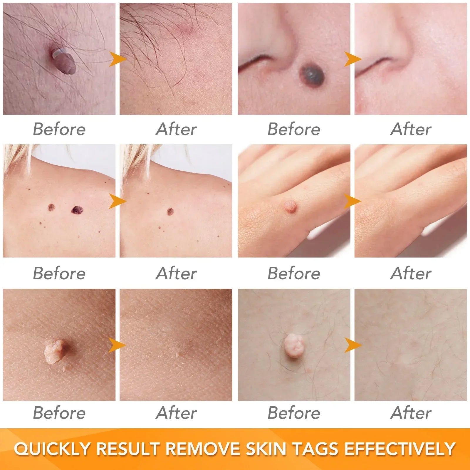 Skin Tag Removal Care Products Simple Wart Removal Tool Set Skin Tag Removeal Tool Easy To Clean Skin Care Tool