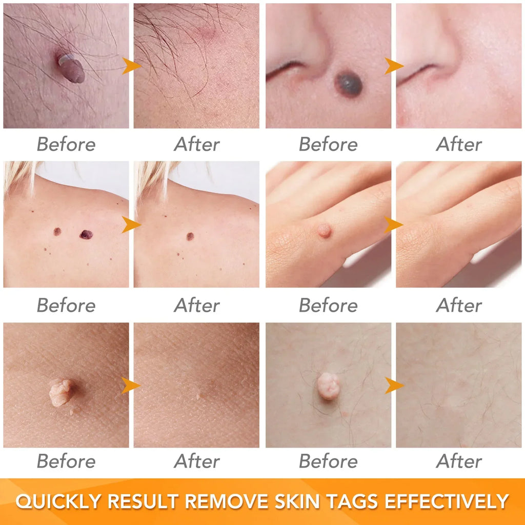 Skin Tag Removal Care Products Simple Wart Removal Tool Set Skin Tag Removeal Tool Easy To Clean Skin Care Tool