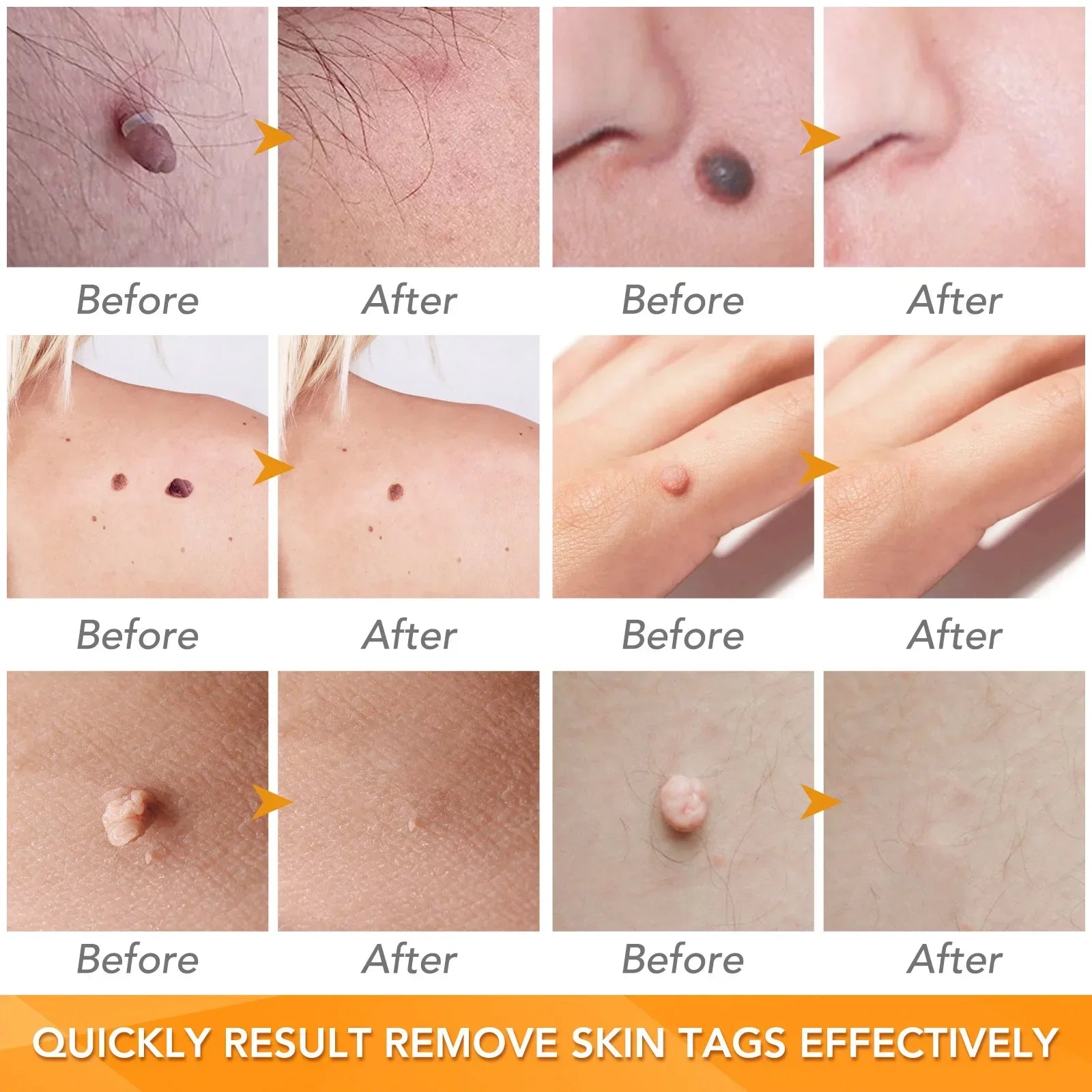 Skin Tag Removal Care Products Simple Wart Removal Tool Set Skin Tag Removeal Tool Easy To Clean Skin Care Tool