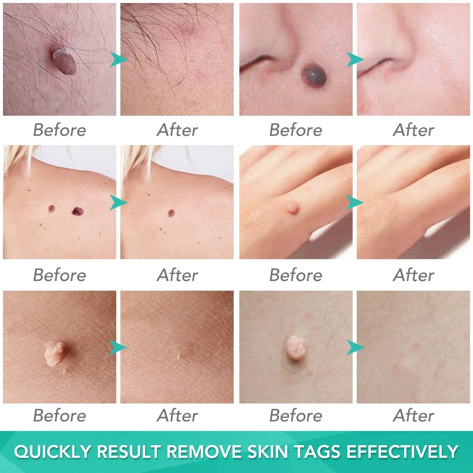 Skin Tag Removal Care Products Simple Wart Removal Tool Set Skin Tag Removeal Tool Easy To Clean Skin Care Tool