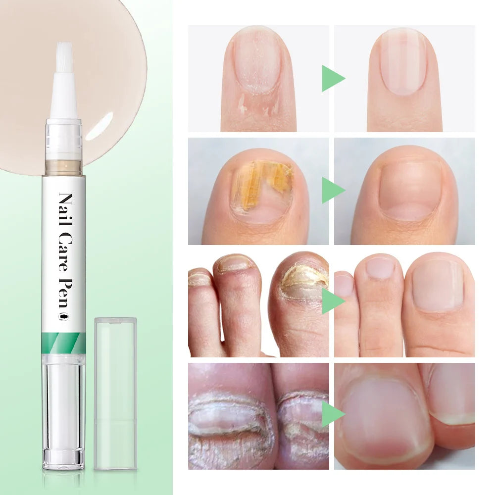 1/2pc Nail Care Mild Ingredients Prevent Damaged Nail Bed Treat Onychomycosis Nail Repair Pen For Nail Beauty Health Care Tool