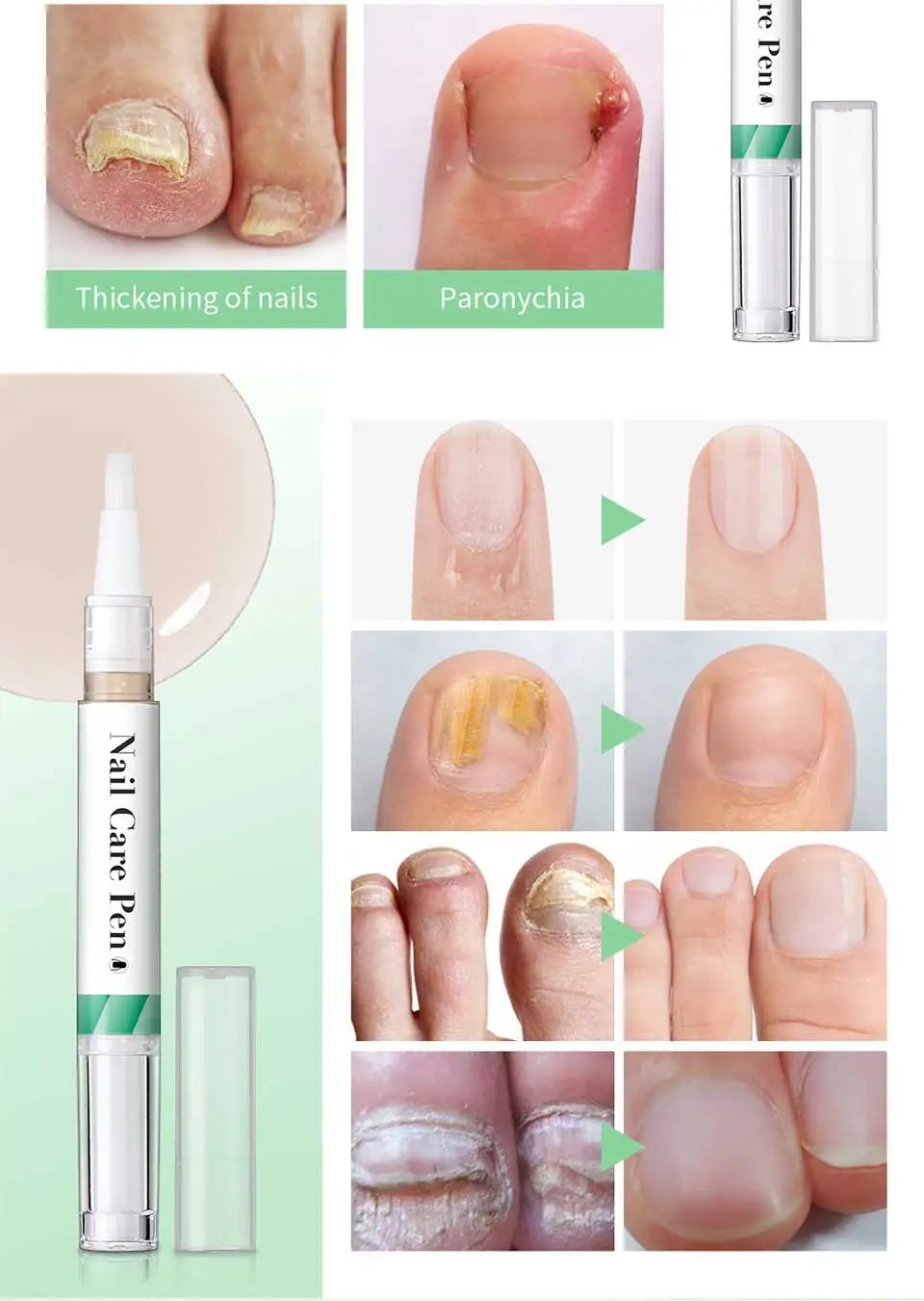 1/2pc Nail Care Mild Ingredients Prevent Damaged Nail Bed Treat Onychomycosis Nail Repair Pen For Nail Beauty Health Care Tool