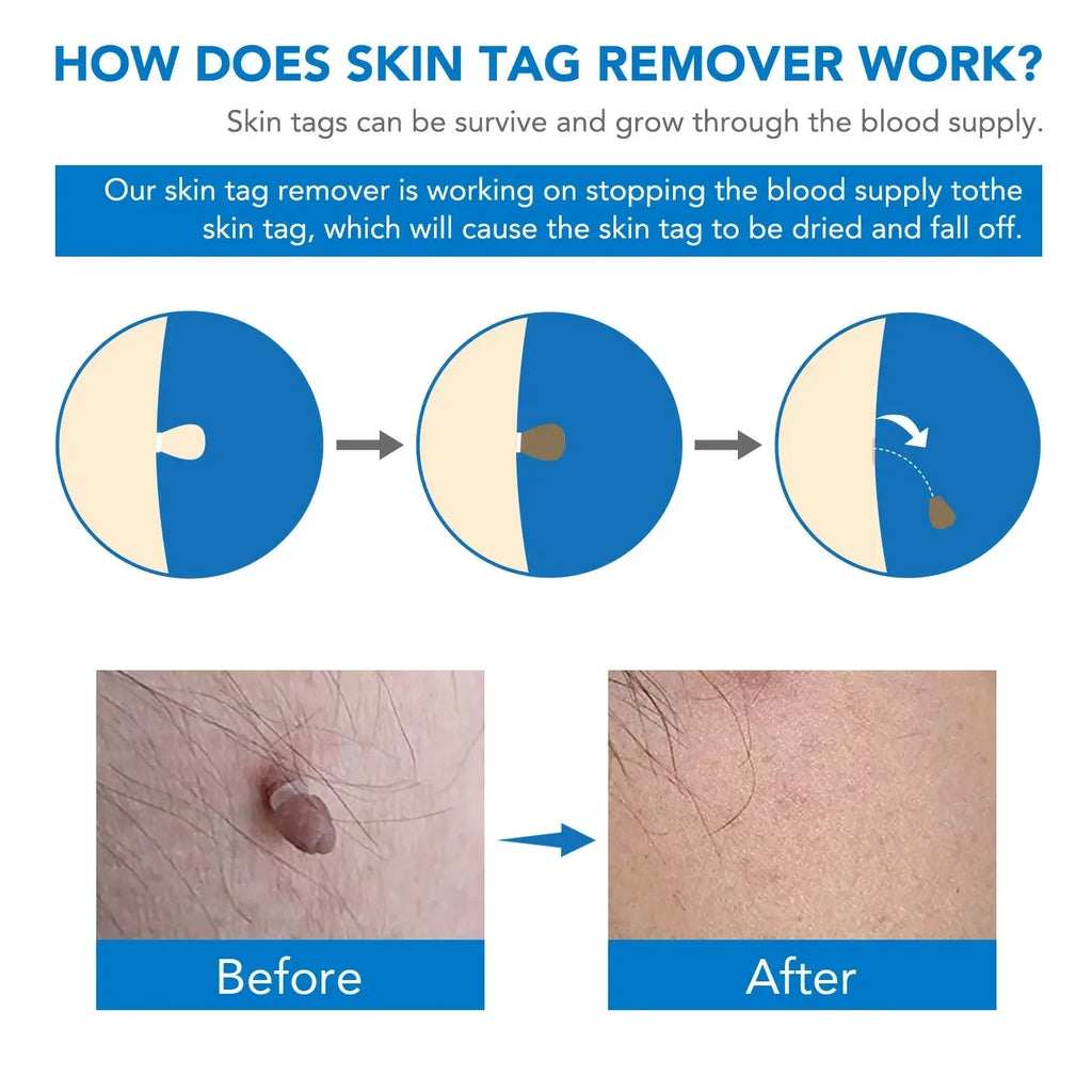 Skin Tag Removal Care Products Simple Wart Removal Tool Set Skin Tag Removeal Tool Easy To Clean Skin Care Tool