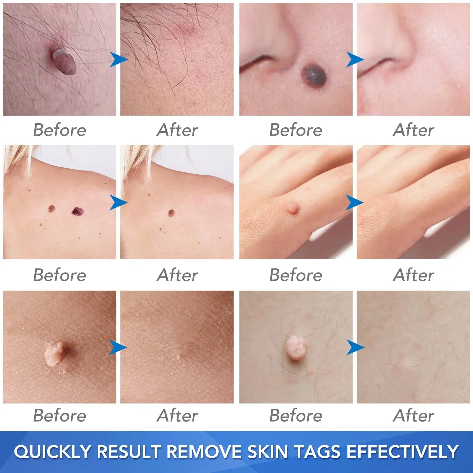 Skin Tag Removal Care Products Simple Wart Removal Tool Set Skin Tag Removeal Tool Easy To Clean Skin Care Tool