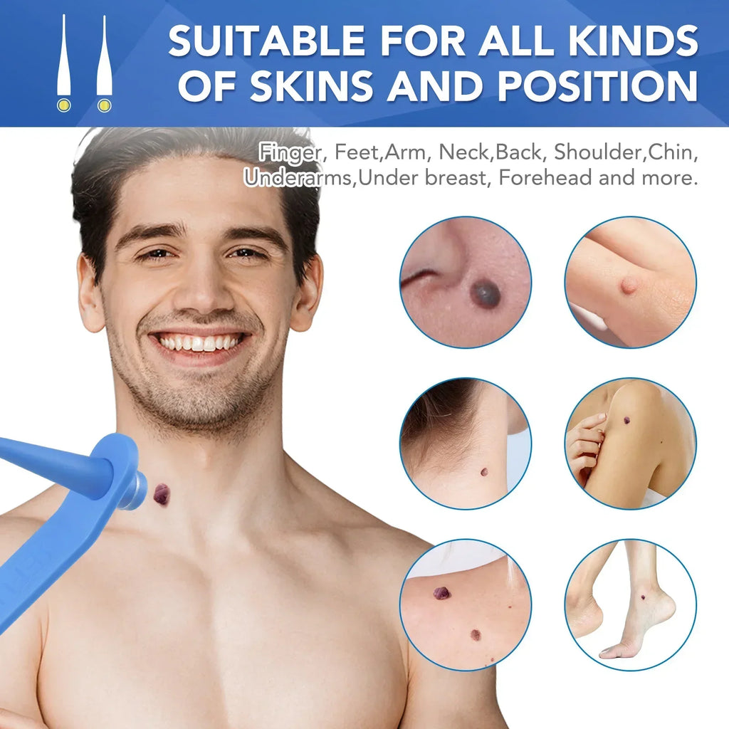 Skin Tag Removal Care Products Simple Wart Removal Tool Set Skin Tag Removeal Tool Easy To Clean Skin Care Tool